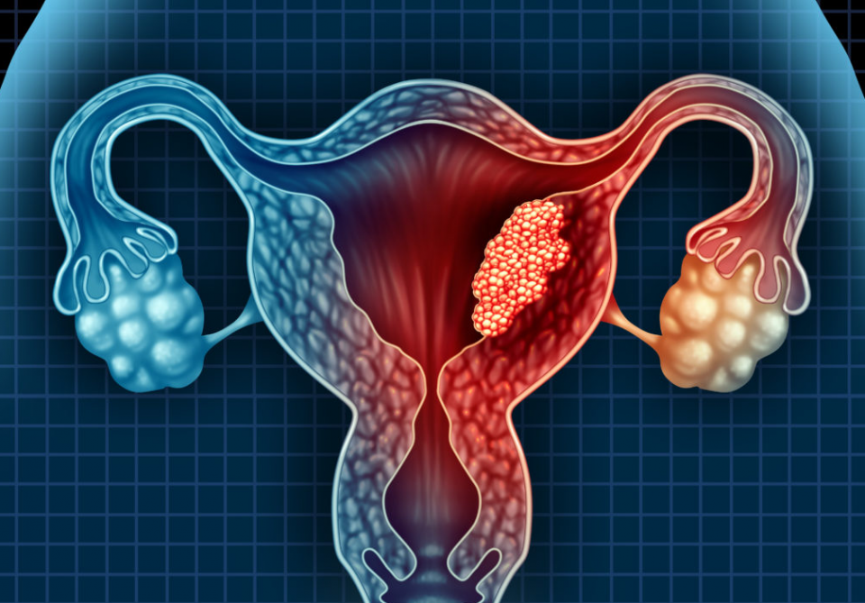 Understanding Uterine Cancer/Treatment: What You Need to Know 