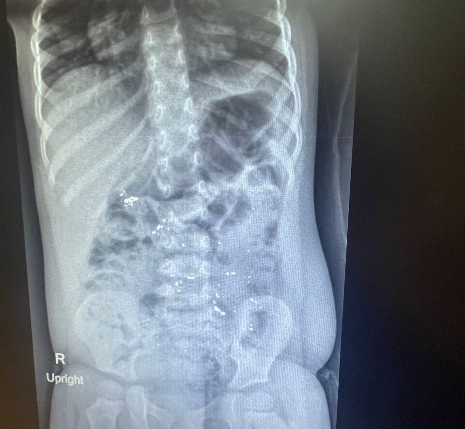 HCMCT Manipal Hospital Dwarka 2-Year-Old Mercury Poisoning